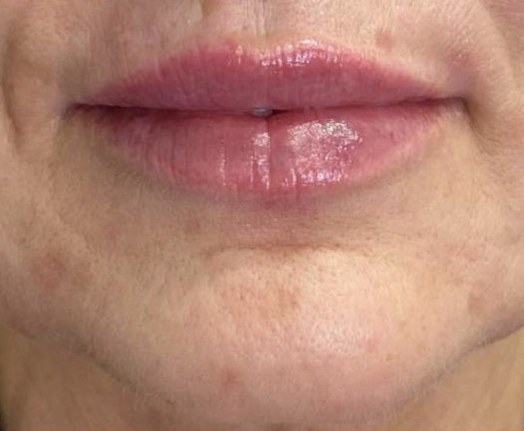 Close-up of lips showing smooth, youthful skin and subtle gloss.